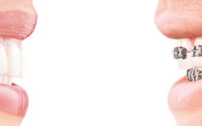 Invisalign®: The Clear Alternative to Braces