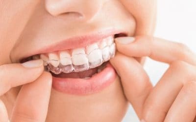 Top 9 Benefits of Invisalign