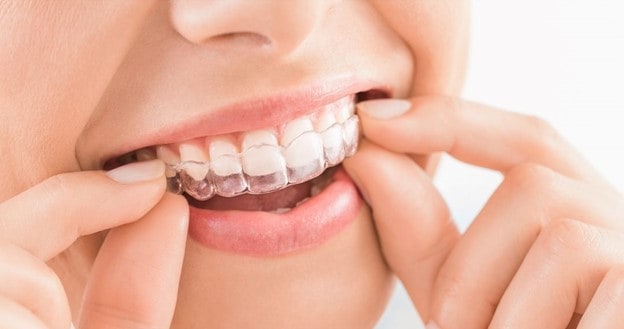 invisalign why invisalign