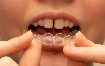 Teeth Shifting Causes, Symptoms, and Treatment Options
