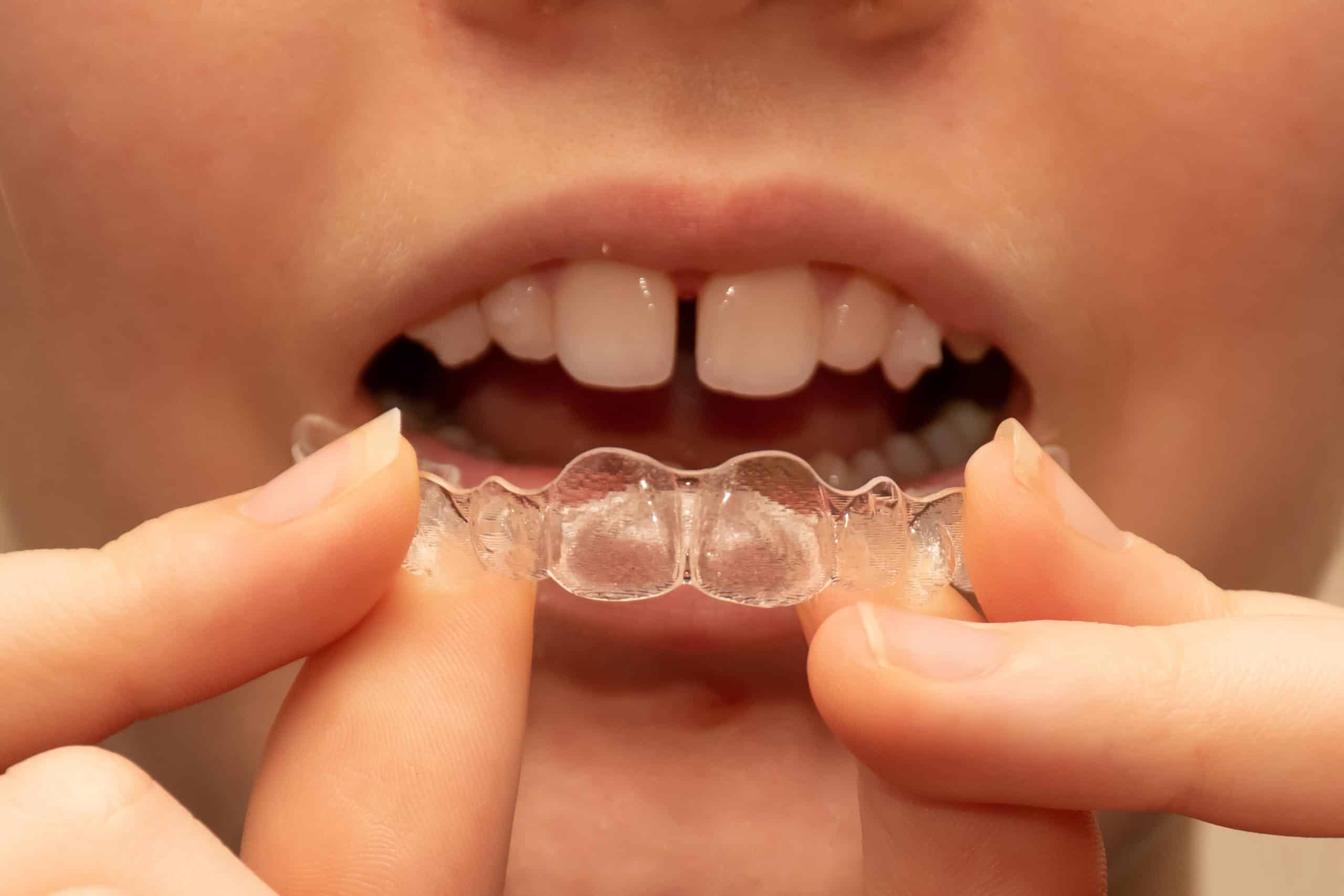 Teeth Shifting