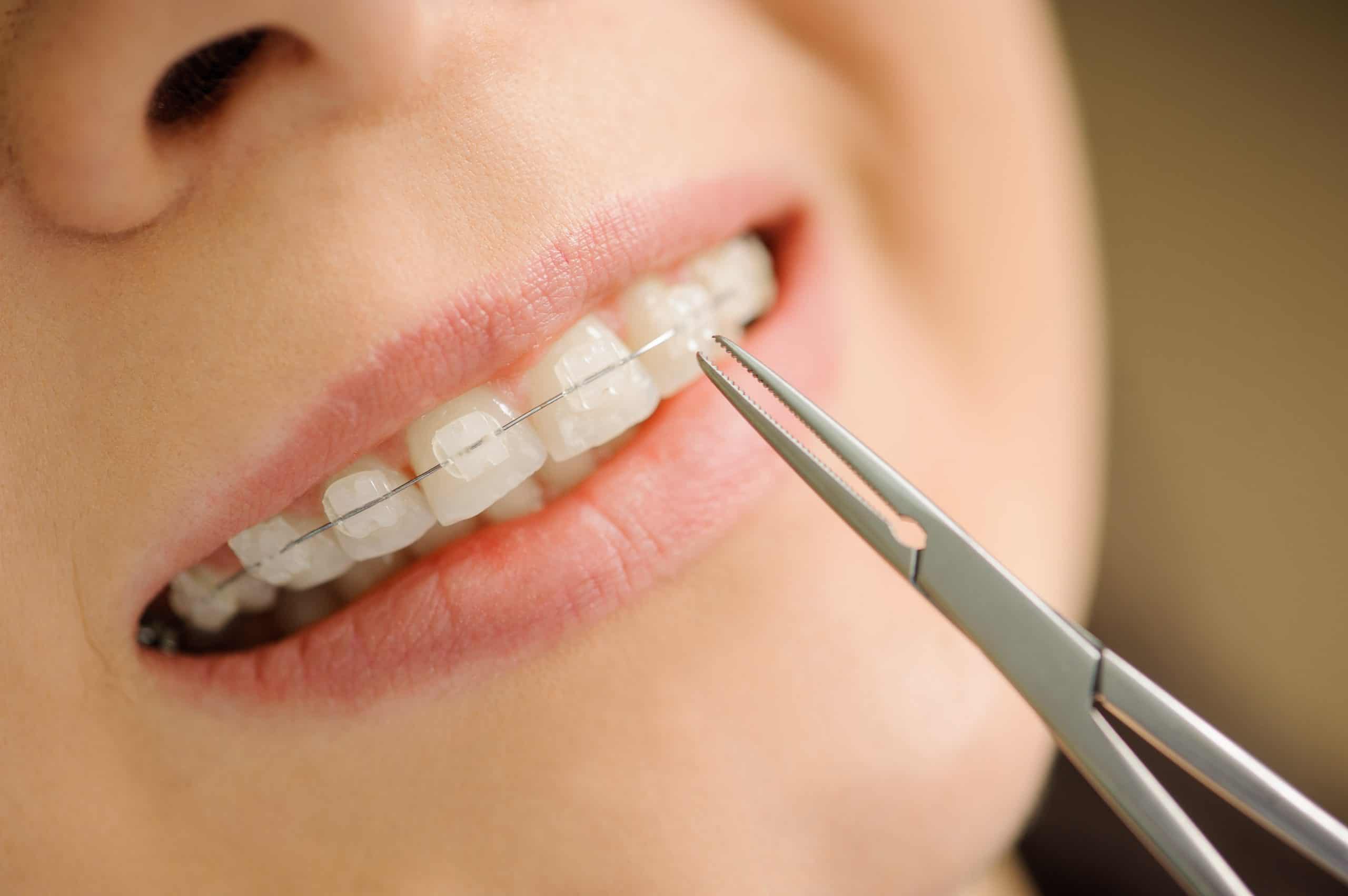 adult ceramic braces adult ceramic braces