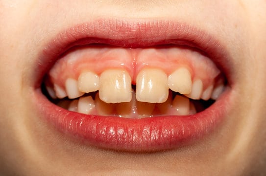 Protrusion Teeth Protrusion Teeth
