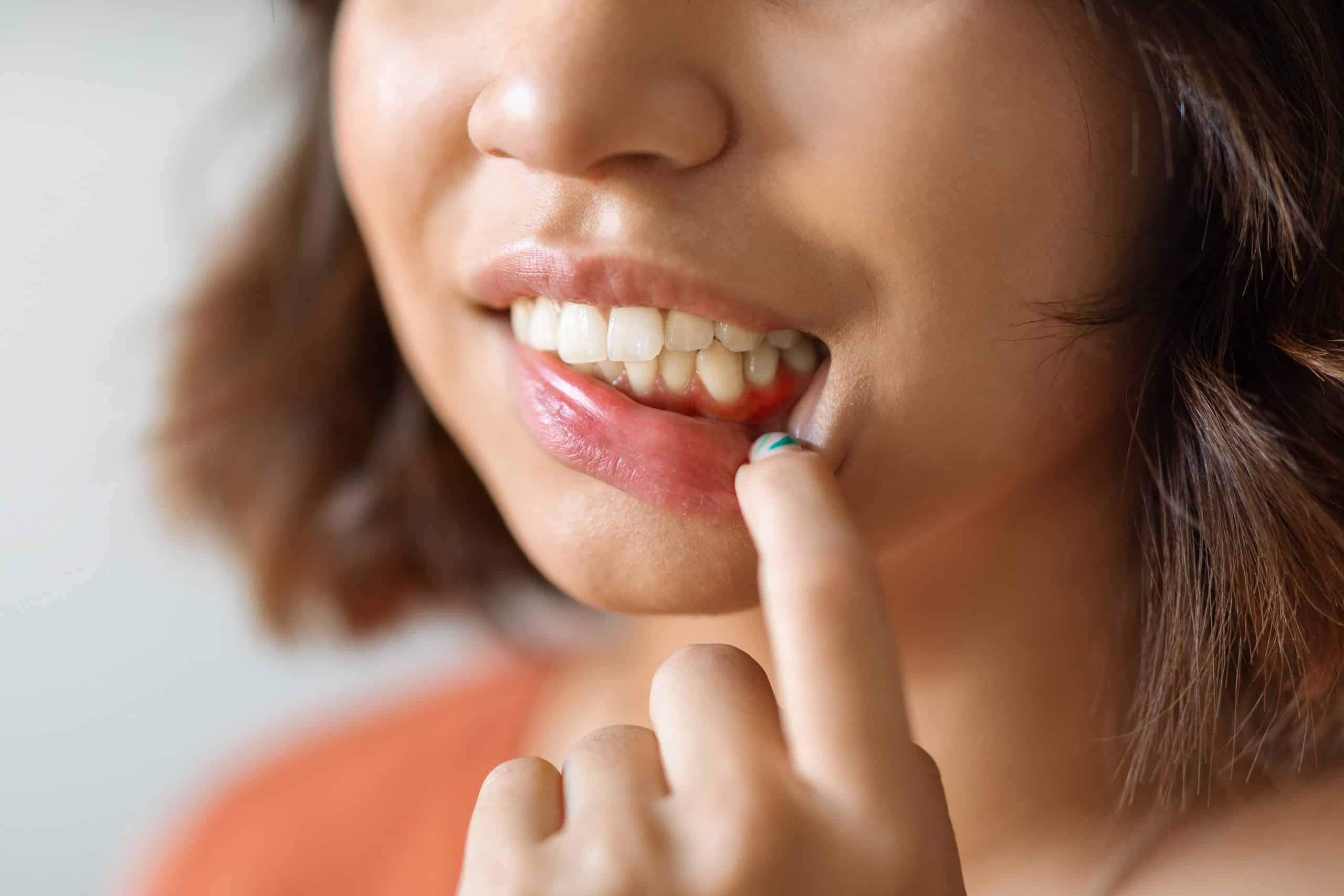 gingivitis treatment gingivitis treatment