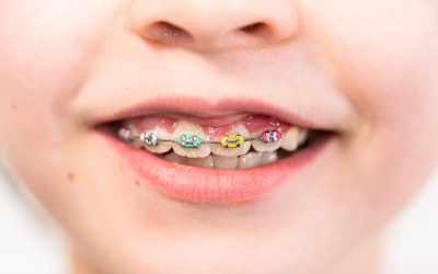 Braces Colors That Make Your Teeth Look Whiter
