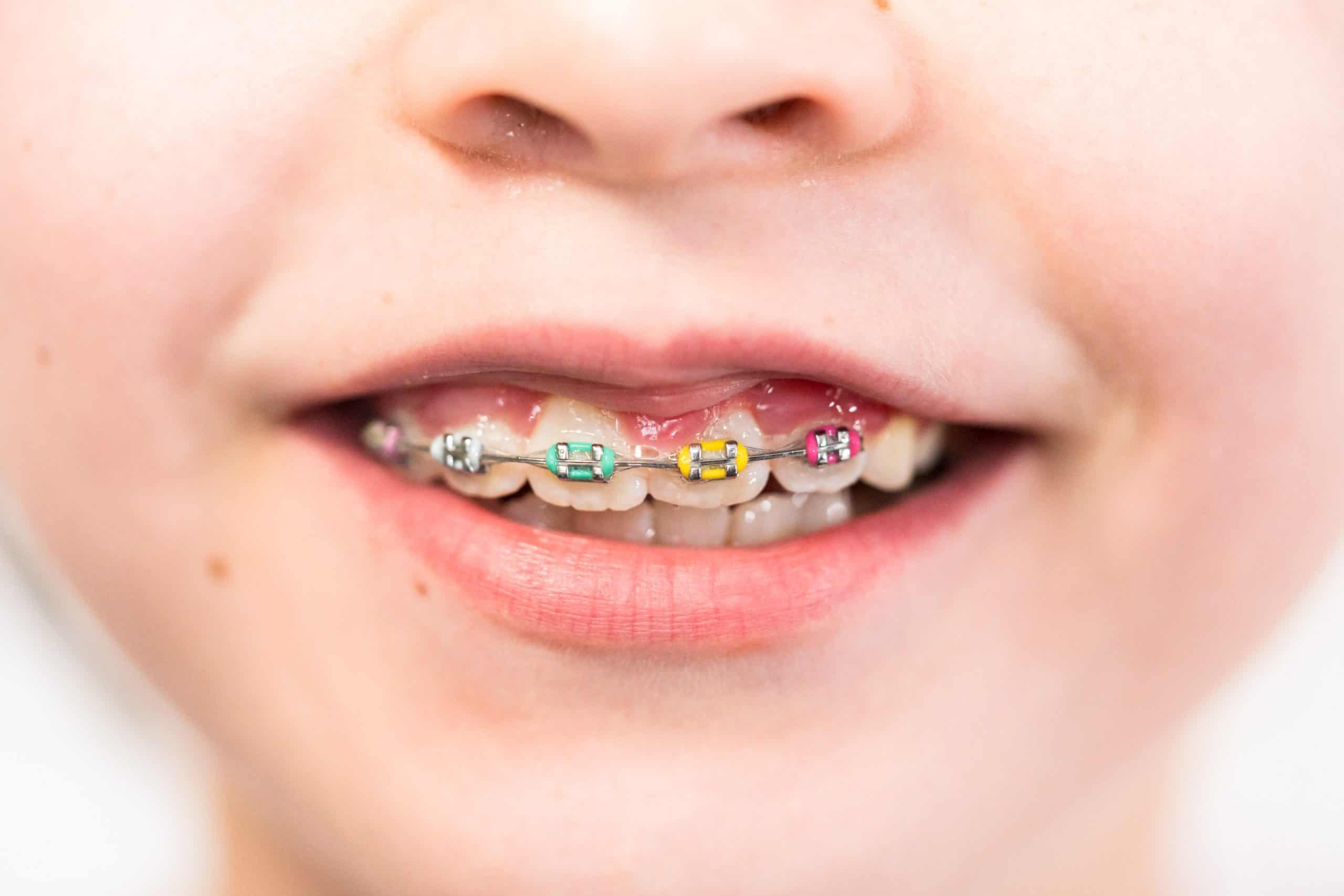 Braces Colors