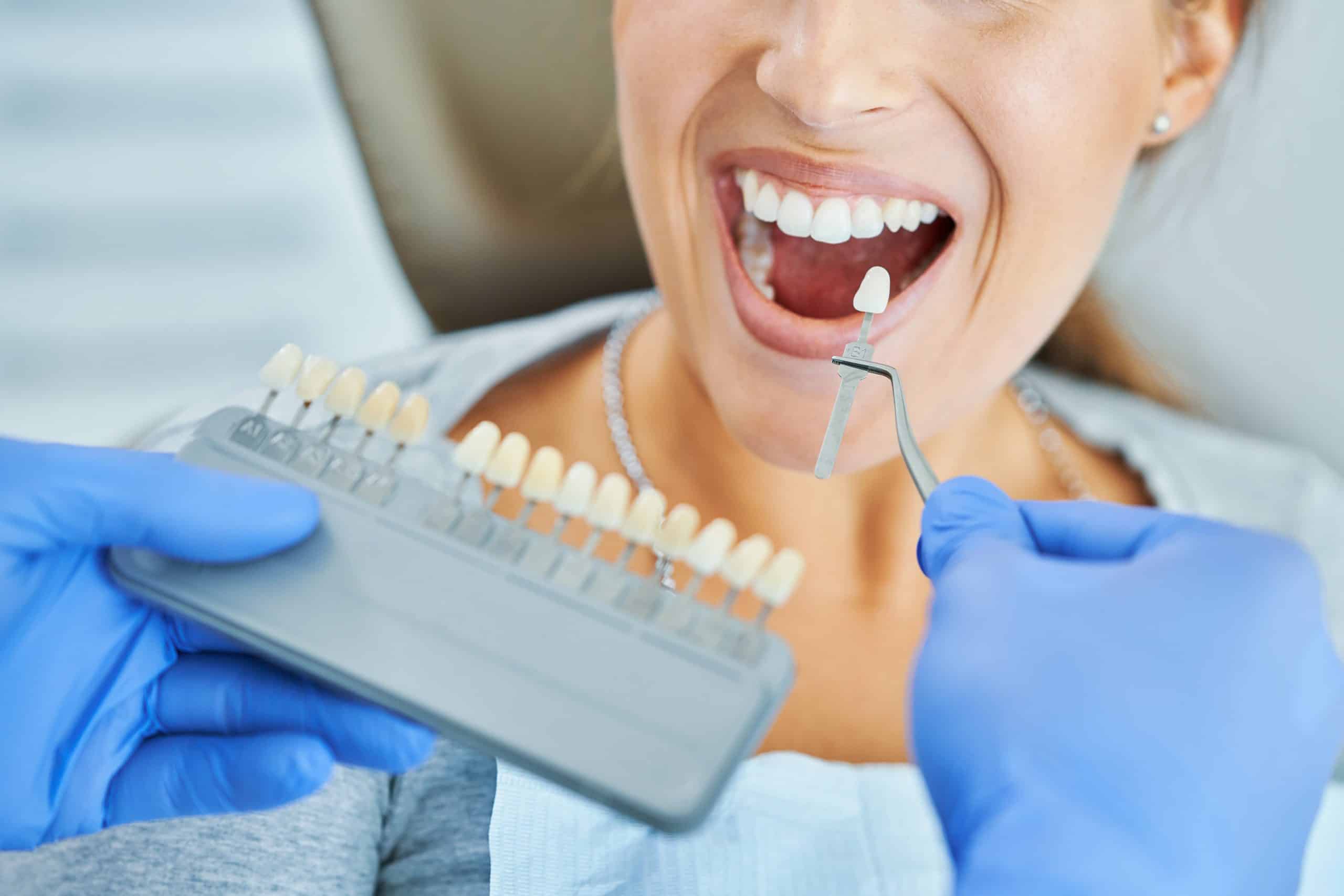 Dental Crowns cost Dental Crowns cost