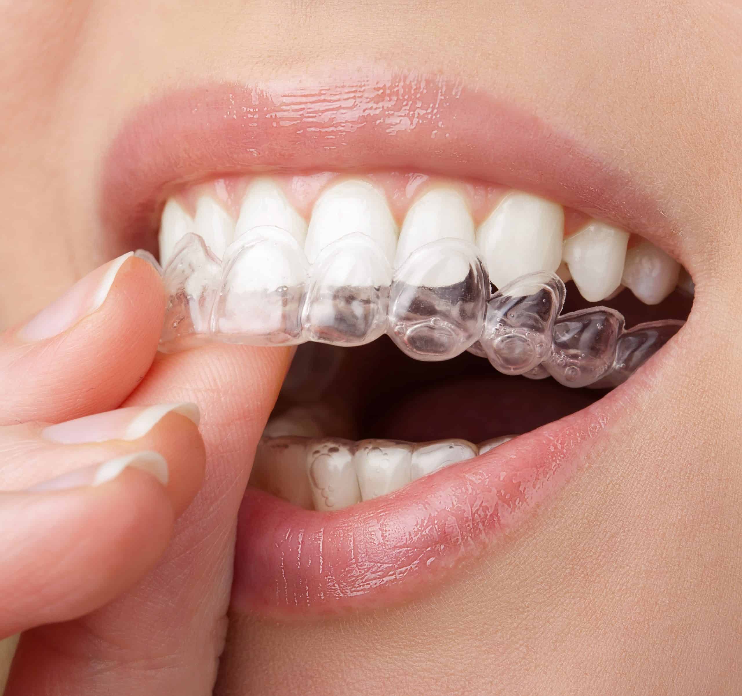 Invisalign Attachments Invisalign Attachments