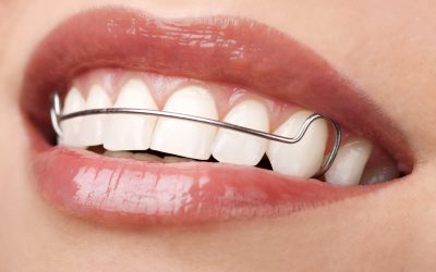 The Different Types of Retainers After Braces