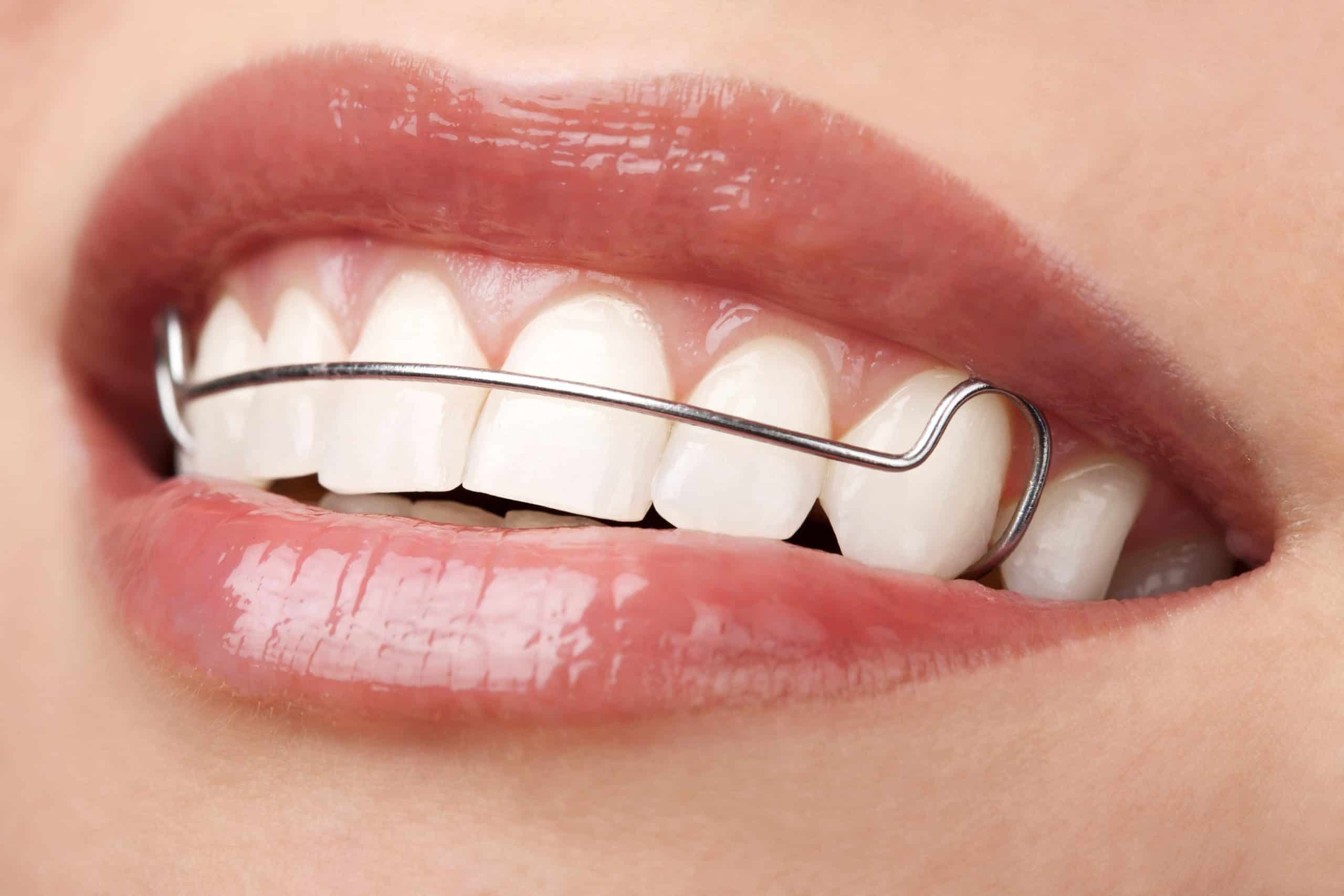 Types of Retainers