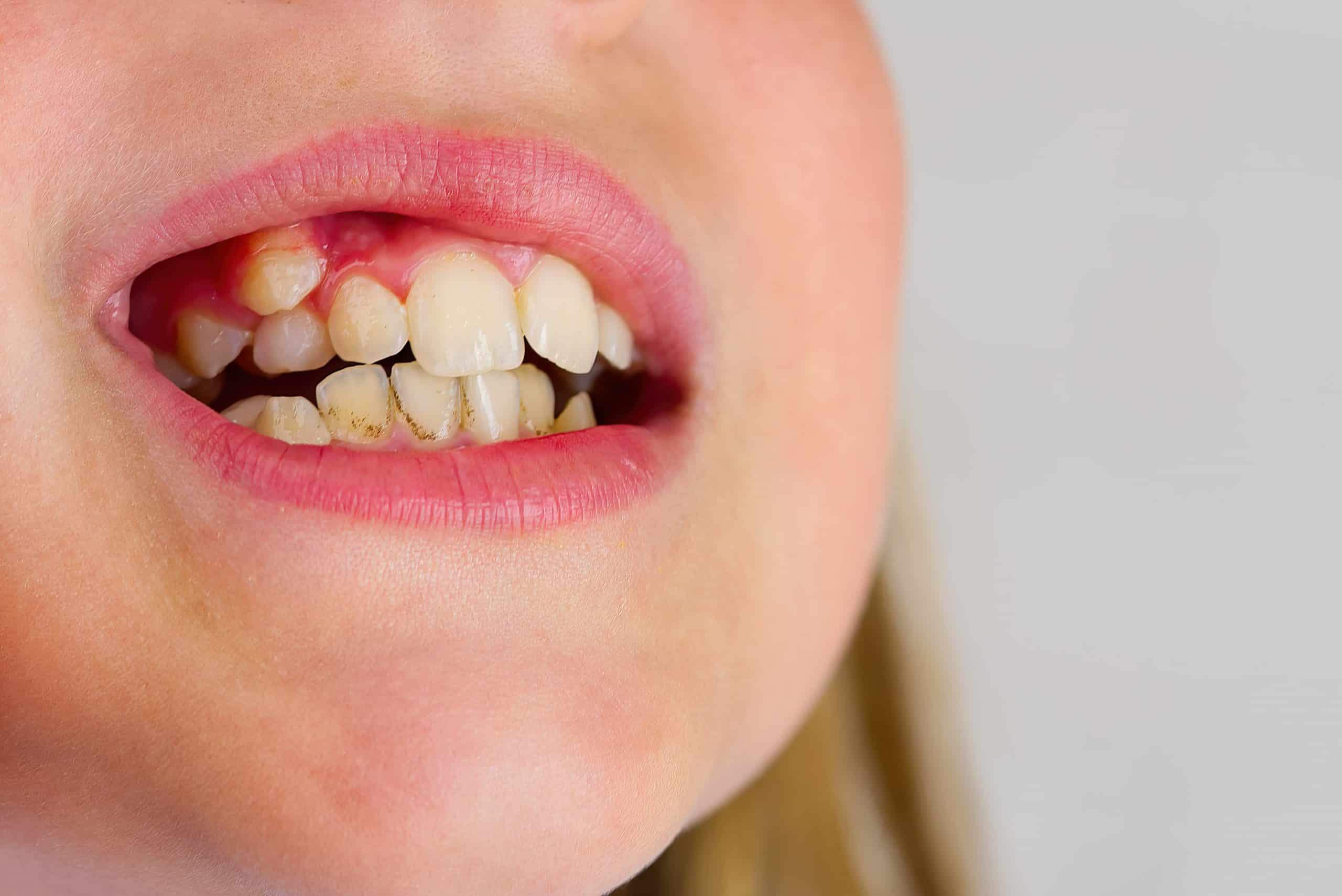 Malocclusion of Teeth Malocclusion of Teeth