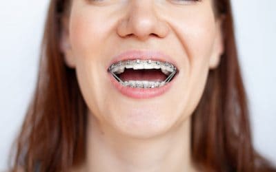 Braces Can Improve The Jaw Alignment