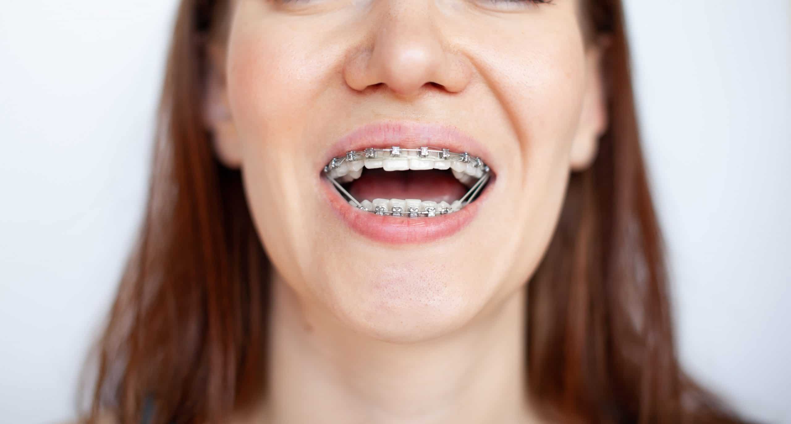 jaw alignment braces
