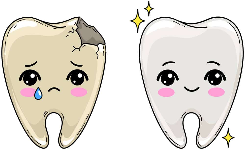 Dental bonding Dental bonding