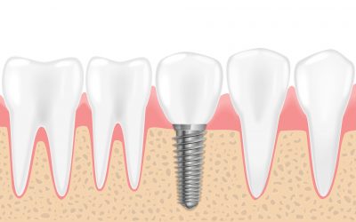 How Dental Implants Can Restore Your Smile and Confidence
