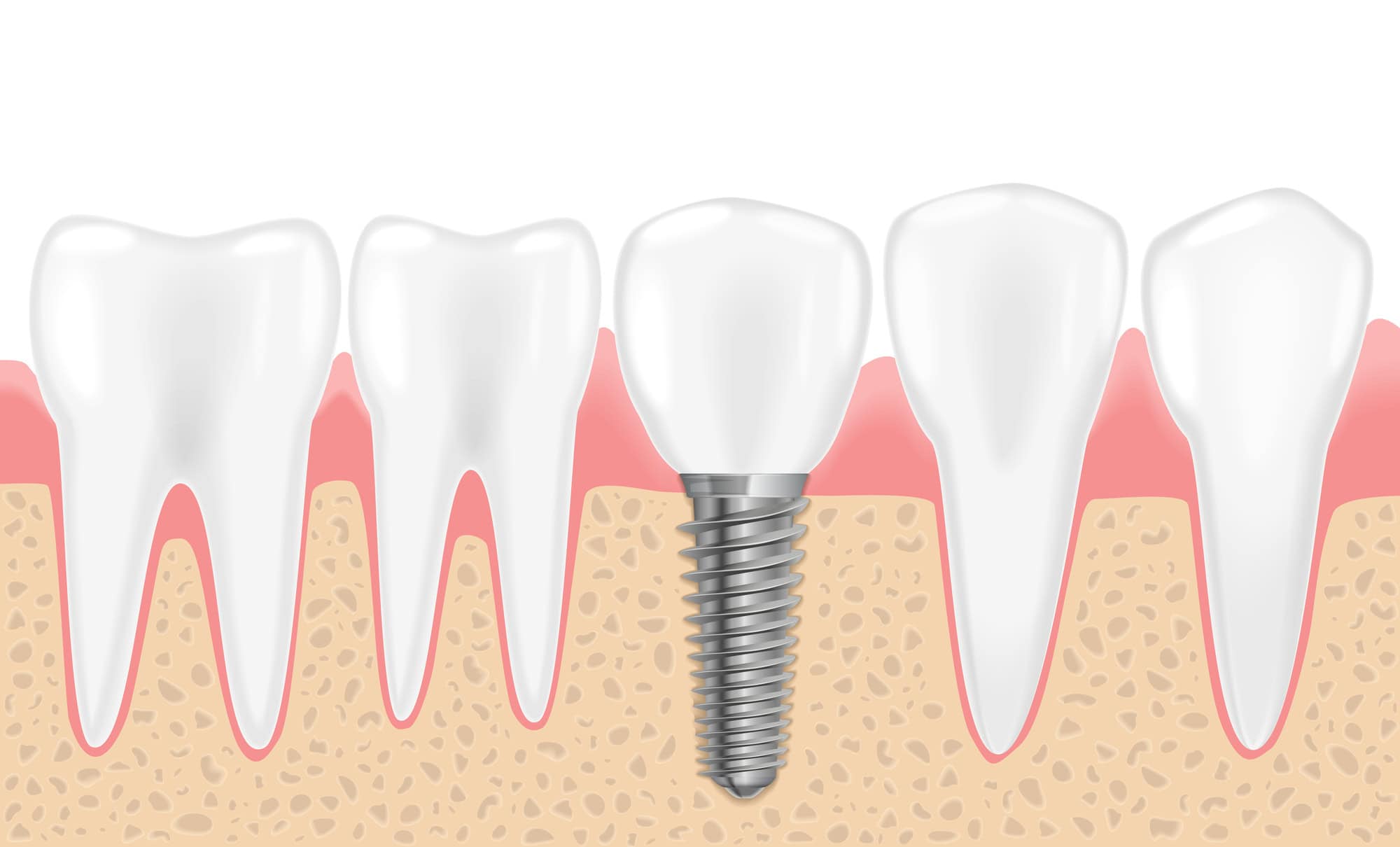 Dental implants Dental implants