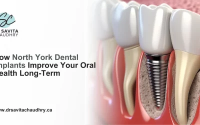 Blog 7 How North York Dental Implants Improve Your Oral Health Long-Term