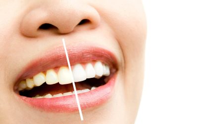 Blog 1 Dental Bonding – Procedure, Cost, Before and After, and How Long It Lasts