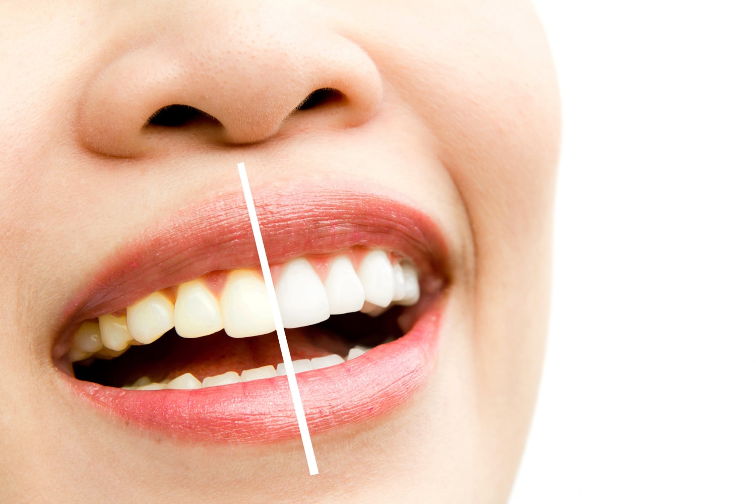dental bonding dental bonding