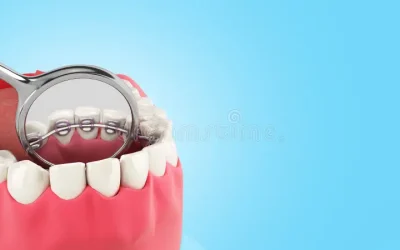 Lingual Braces: Pros & Cons, Cost, and Invisalign Comparison