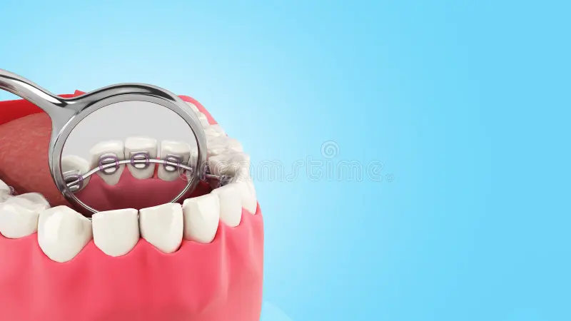 lingual braces lingual braces
