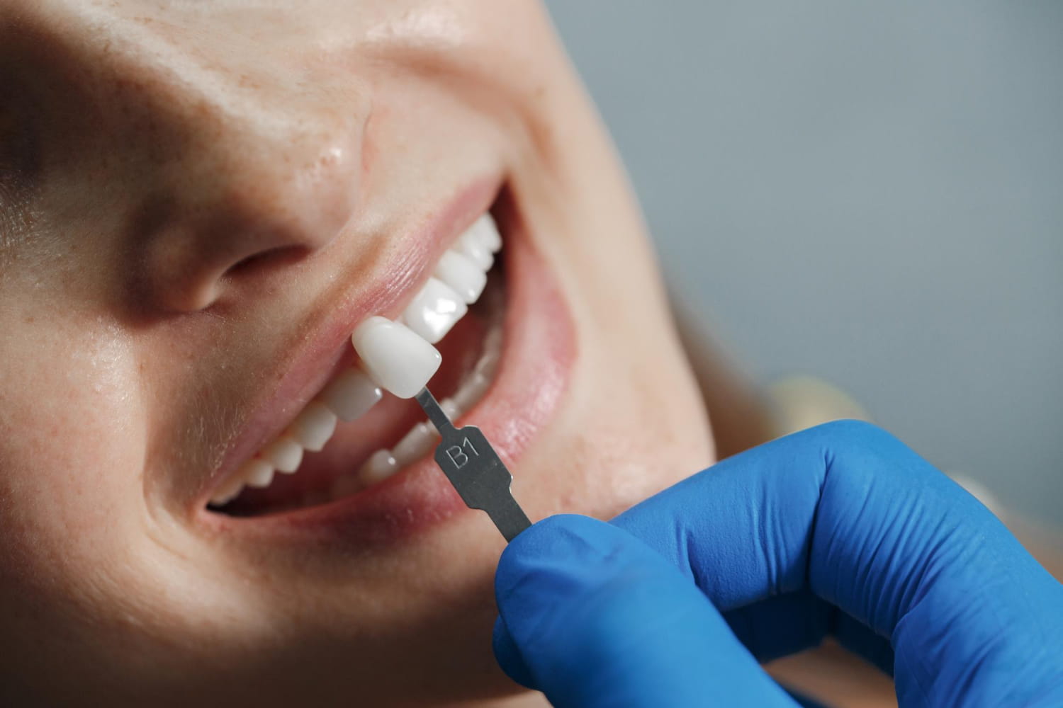 Composite vs Porcelain Veneers Composite vs Porcelain Veneers