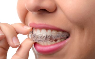 Invisalign Refinements Explained – Why Some Patients Need Extra Aligners?