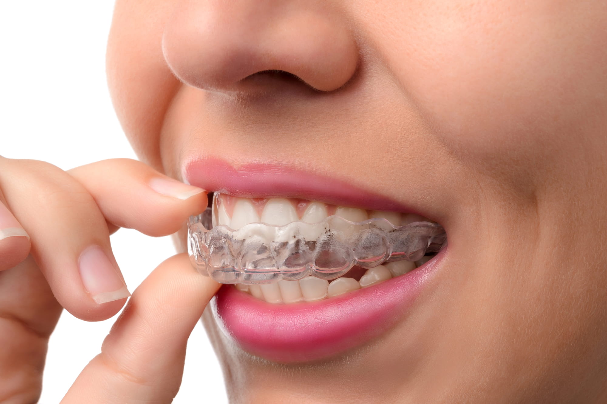 Invisalign Refinements Invisalign Refinements
