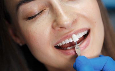 What Are Veneers and How Do They Work?