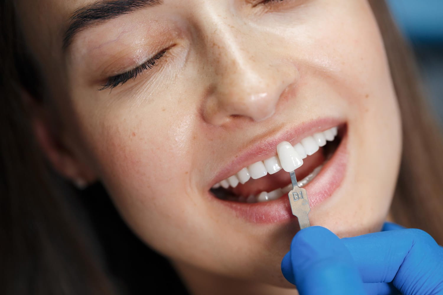 what are veneers and how do they work what are veneers and how do they work